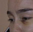 女子找"野鸡美容院"做微整形 致眼部血管破裂(图) - 广西新闻网